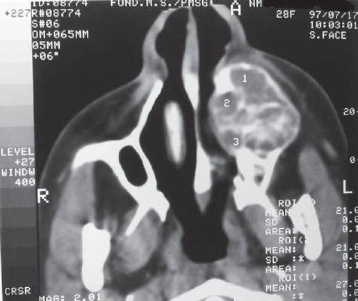 Tomografia computadorizada destacando GCCG manifestando-se como imagem multilocular na região anterior esquerda da maxila. Figura 3.