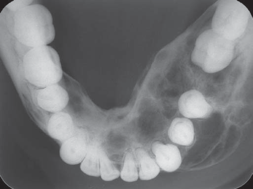 Tumor marrom do hiperparatireoidismo (grupo B) em corpo mandibular do lado direito manifestando-se como imagem radiolúcida unilocular de contorno bem definido, causando deslocamento do primeiro