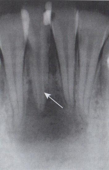 O dente é facilmente localizado, há dor à percussão e há pouca ou nenhuma reação a mudanças de temperatura. O frio pode aliviar a dor.