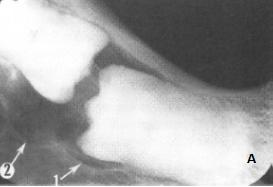 Estes quistos podem deslocar os dentes por distâncias consideráveis e também podem causar reabsorções das raízes dos dentes adjacentes.