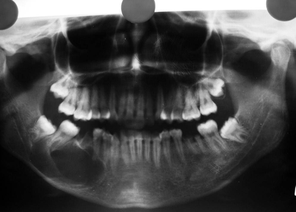 Fig. 7. Ameloblastoma. Imagem radiolúcida de um ameloblastoma unicístico localizado no 4º quadrante.