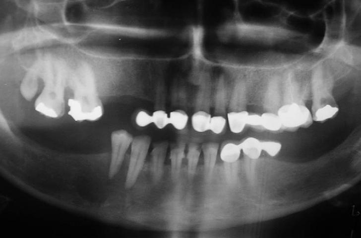 Imagem radiolúcida bem circunscrita com bordo mal definido e alargamento do ligamento periodontal na região periapical do segundo pré molar inferior direito.