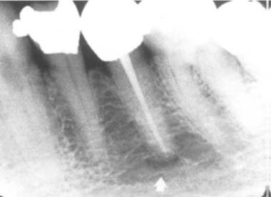 Pela observação clínica e radiográfica, o envolvimento do alvéolo pode-se assemelhar a doença periodontal ou, em algumas ocasiões um tumor metastático pode causar alargamento do ligamento periodontal.