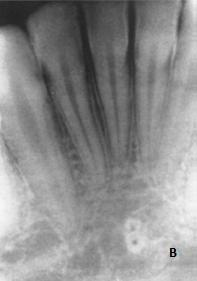 7,25 Características radiográficas Visualiza-se bem abaixo dos ápices dos dentes incisivos inferiores, na linha média.