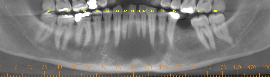 Figura 2: Radiografia panorâmica inicial. Em tomografia computadorizada, observou-se área hipodensa entre os forames que se estendia da basilar aos dentes envolvidos.