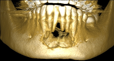 22 Figura 4: Reconstrução 3D de mandíbula, mostrando perda parcial da cortical anterior vestibular. Figura 5: Reconstrução 3D de mandíbula, mostrando perda parcial da cortical anterior lingual.