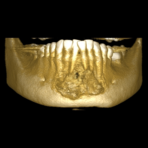 24 Figura 7: Reconstrução 3D de mandíbula após 4 meses de
