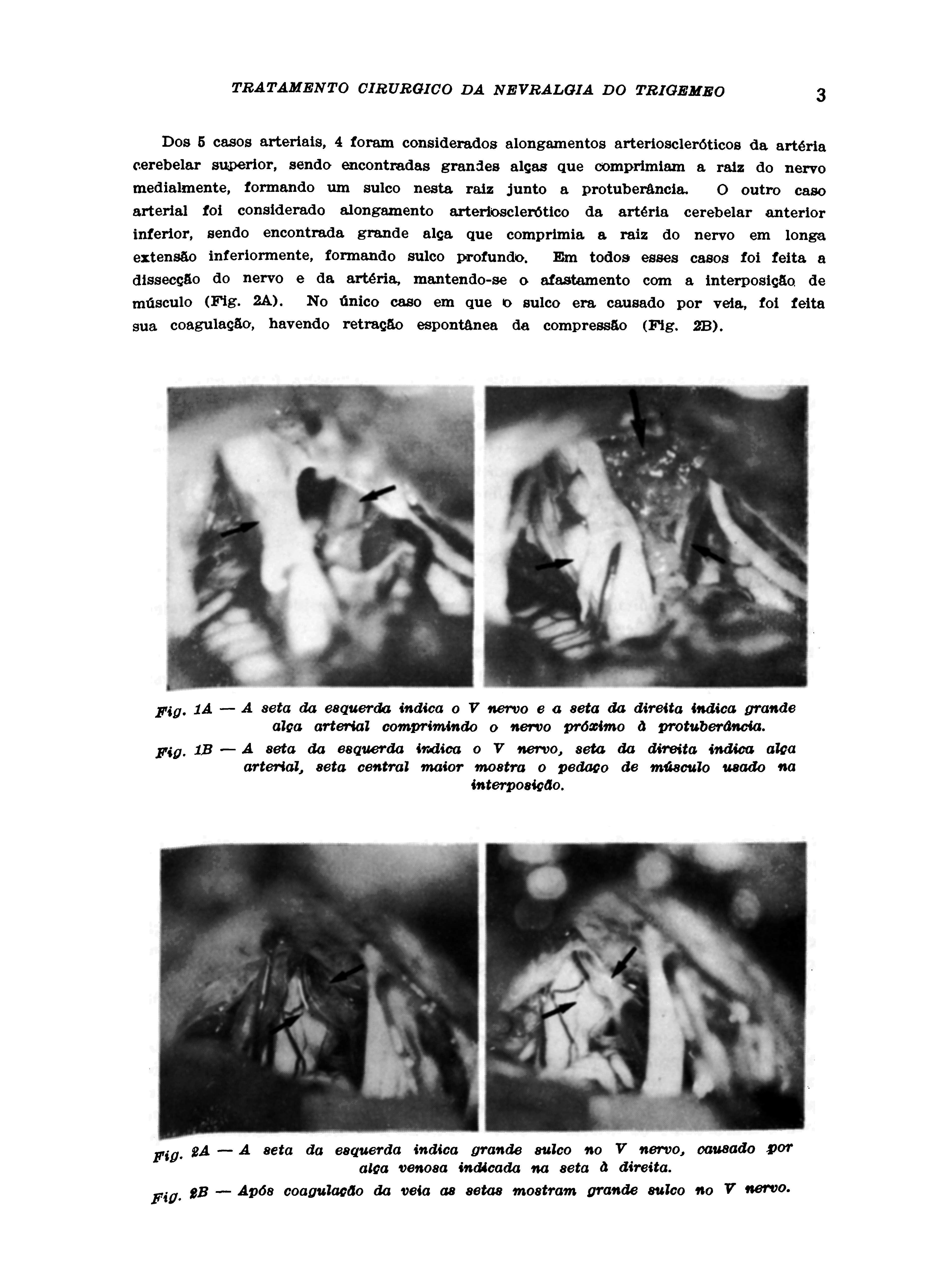 Dos 5 casos arteriais, 4 foram considerados alongamentos arterioscleróticos da artéria cerebelar superior, sendo encontradas grandes algas que comprimiam a raiz do nervo medialmente, formando um