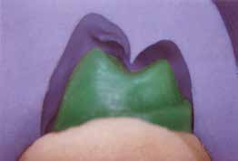 cunhagem de próteses combinadas Muralha para inclusão de prótese total (isolamento dentes/gesso em mufla) PERFORMANCE Biocompatibilidade Altíssima fluidez Resistência ao calor extremamente alta
