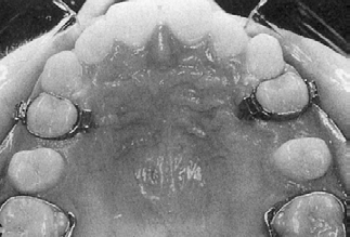 distalmente ao braquete do primeiro pré-molar e o outro na extremidade distal do tubo do molar (FIG. 3,4).