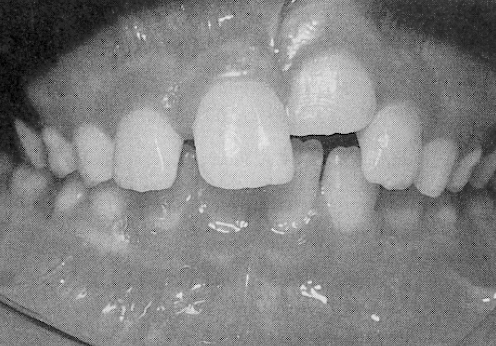 Síntese Tratamento de um Incisivo Central Anquilosado através da Osteotomia Dento-Alveolar Individual Treatment of an ankylosed central incisor by single-tooth dento-osseous osteotomy A anquilose de