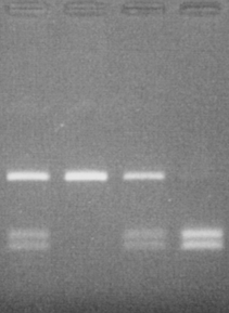 PCR e Restrição Enzimática (Bsu 36 I) Mutação: c.20a>t (p.glu6val) 2.