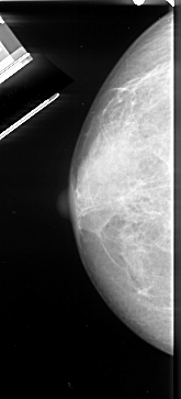 reening Mammography [DDSM