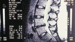 de antecedentes traumáticos pessoais 8 indivíduos apresentaram histórico de lesões traumáticas de coluna vertebral lombar (20%).