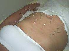 Acupunctura A palavra acupunctura originária do latim, sendo que acum significa agulha e punctum significa picada ou punção.