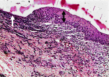16 Figura 2. Fotomicrografia apresentando hiperplasia de epiderme (seta preta), área de ulceração (seta branca) e infiltrado inflamatório no cório (asterístico).