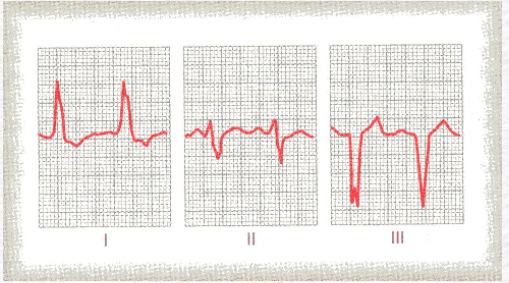 Padrões prolongados e bizarros do complexo QRS Padrões bizarros do complexo QRS são provocados frequentemente por duas condições: (1) destruição do músculo cardíaco ventricular em várias áreas do