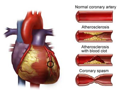 Isquemia coronária Um fluxo insuficiente de sangue deprime o metabolismo do músculo cardíaco por várias razões: (1) Falta de oxigénio; (2) Acumulação excessiva de dióxido de carbono; (3) Falta dos