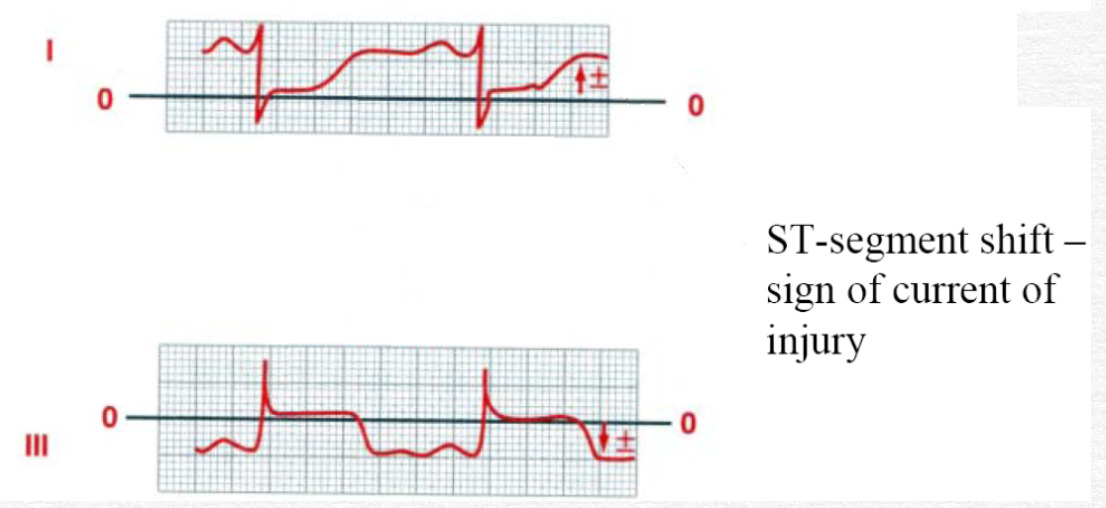 Como calcular o vector da corrente de lesão a partir do ECG?