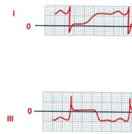 Como calcular o vector da corrente de lesão a partir do ECG? Durante o segmento ST todo o músculo cardíaco se encontra despolarizado, portanto, não há d.d.p. à superfície do coração. Idealmente, as d.