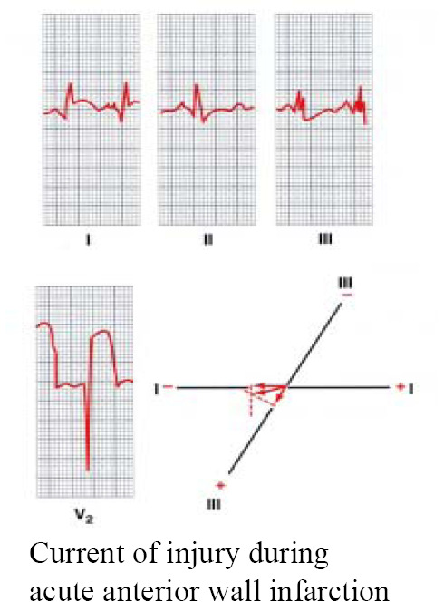 Enfarte agudo da parede anterior do miocárdio Zonas externamente negativas (despolarizadas) - Lesão. Zonas externamente positivas (repolarizadas) Tecido saudável.