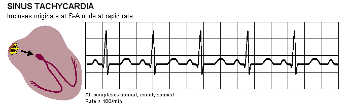 Ritmos anormais do nó sinusal A taquicardia é caracterizada por um rápido batimento cardíaco, tipicamente superior às 100 batidas por minuto.