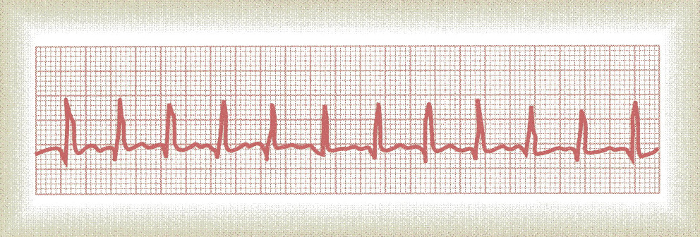 4=150 As causas típicas da taquicardia são aumento da temperatura corporal, estimulação do coração pelos nervos simpáticos e várias condições tóxicas.