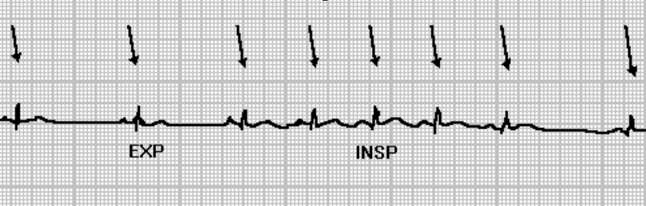 É mediada pela modulação do actividade simpática e parassimpática. O ciclo respiratório induz flutuações na pressão sanguínea.