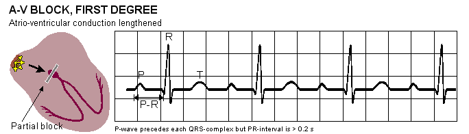 Bloqueio dos sinais cardíacos nas vias de condução intracardíacas Num bloqueio AV de primeiro grau o intervalo PR é superior a 200 ms, mas o coração encontra-se a