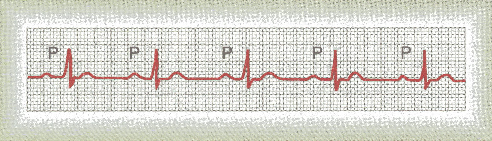 No coração saudável em repouso o tempo médio entre o começo da onda P e o começo do complexo QRS é de 160 ms.