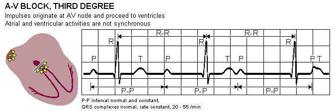 Bloqueio dos sinais cardíacos nas vias de condução intracardíacas Num bloqueio AV de terceiro grau ou bloqueio AV completo não passa qualquer impulso das aurículas para os ventrículos.