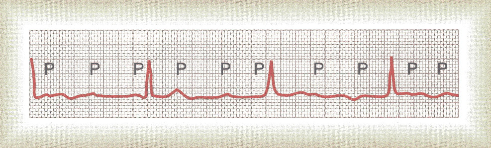 Como se pode observar na figura (derivação II) a frequência de batimento das aurículas é de cerca de 100 batimentos por minuto (60/0.