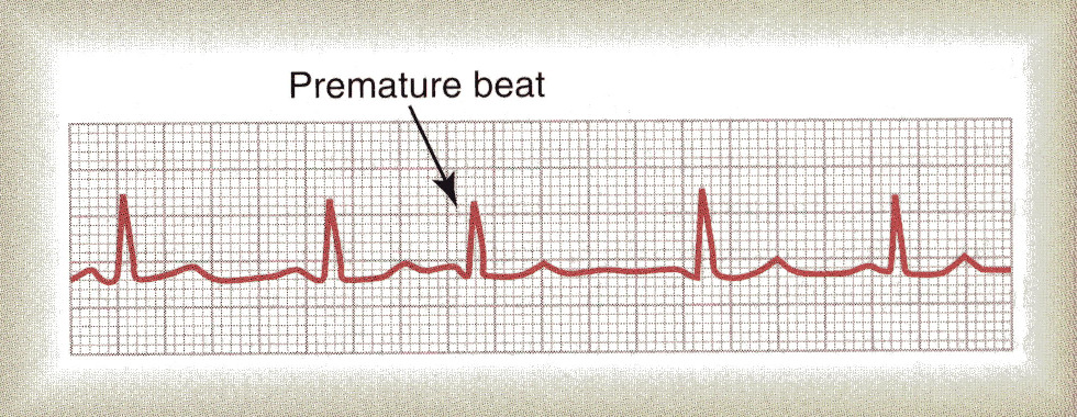Contracções auriculares prematuras A figura (derivação I) mostra uma contracção auricular prematura com a onda P a ocorrer demasiado cedo, e com diminuição do intervalo PR.