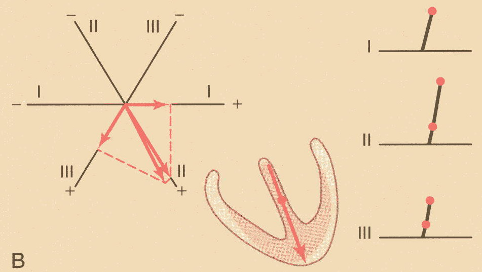Análise vectorial do electrocardiograma normal Do septo interventricular a despolarização espalha-se para as superfícies endocárdicas de ambos os ventrículos.
