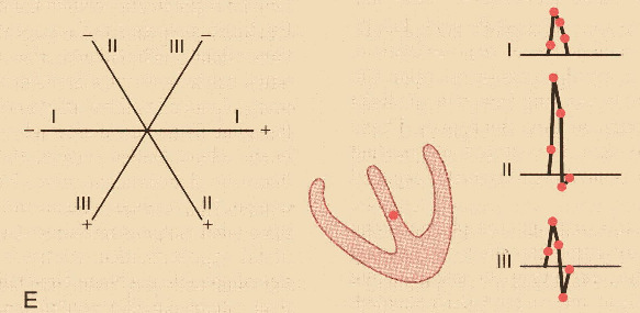 Análise vectorial do electrocardiograma normal Todo o ventrículo está despolarizado.