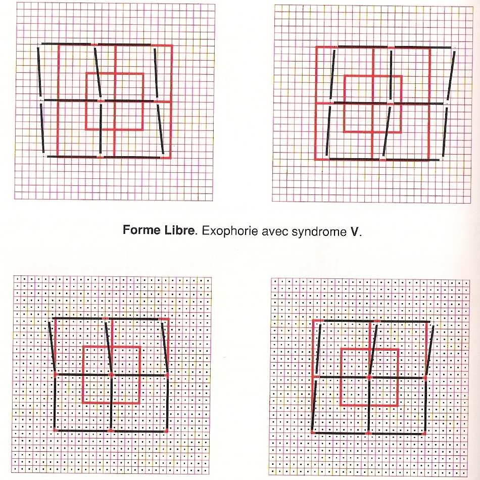 Forma Livre. Exoforia com padrão em V. Forma Múltipla.