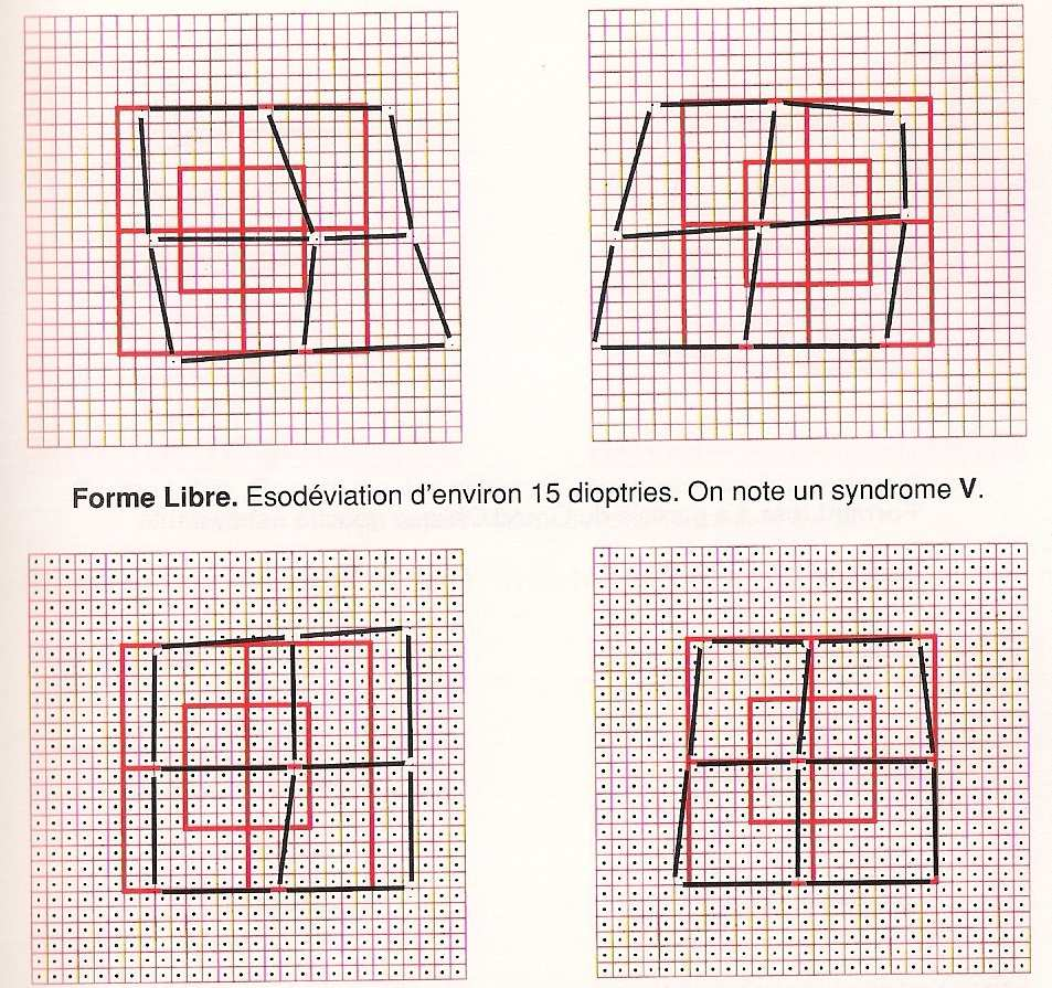 Quando é a forma livre que está a ser realizada, há maior tendência para a supressão pois a dissociação é forte, por outro lado, na forma múltipla a fusão é estimulada, havendo tendência para a