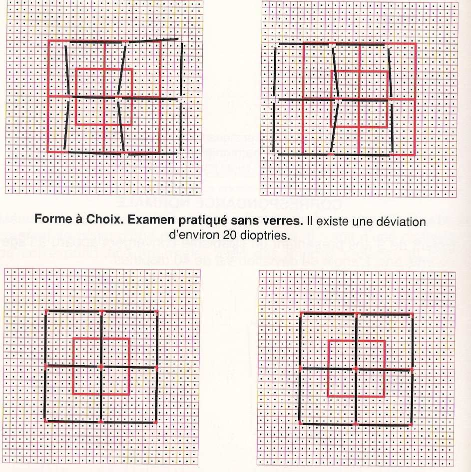 Existe correspondência retiniana normal. Estrabismos Acomodativo. Forma Múltipla.