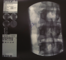 boembólico. Ainda no PET-TC foi evidenciado, além dos nódulos pélvicos (Figura 2), vistos à cirurgia, implante em hilo hepático (Figura 3).