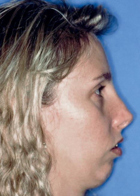 rígida em pacientes com padrão facial de Classe II FIGURA 2 -