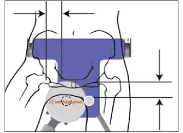 Figura 9 7S.(Opcional): Encaixe a placa de transferência do pacientes e a almofada ao extensor da mesa para a posição supina. 8S.