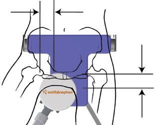 Página 14 1S. Posicione a parte inferior da zona da pélvis do paciente de forma a ficar devidamente assente dentro da almofada do apoio perineal - cerca de 7,6 cm (Figura 12-A).