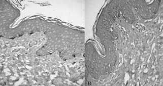 de processos dendríticos (Figuras 2 e 3). Na pele lesada, em dois casos o marcador HMB-45 mostrou a presença de raros melanócitos, enquanto o Melan-A evidenciou ausência destes (casos 2 e 4).