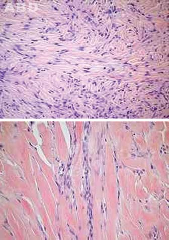 Histiocitomas fibrosos: revisão histopatológica de 95 casos 215 FIGURA 7: Padrão estoriforme do colagénio; Hialinização e esclerose hiperplasia pseudocarcinomatosa em 1% dos HF, achado raramente