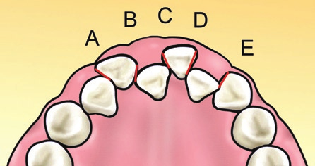 Castro, R. C. F. R.; Freitas, M. R.; Janson, G.; Freitas, K. M. S. pontos de contato anatômico dos dentes ânteroinferiores (Fig. 4).