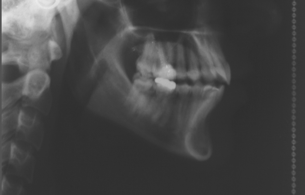 (Figura 4), empregando-se o mesmo aparelho de raios X, pertencente à Associação Brasileira de Odontologia (ABO-Uberlândia/MG), marca ROTOGRAFIC PLUS, modelo MR05, tipo 84086511, 85KV, 10 ma,