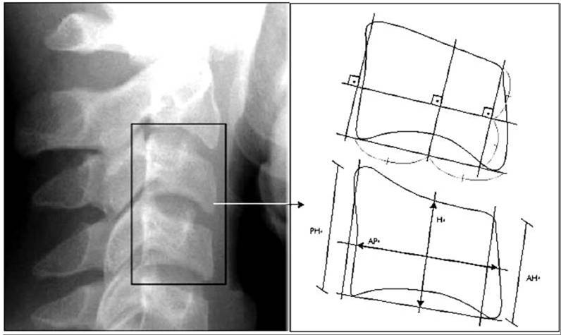 Figure 1: Body of cervical vertebrae C3 and C4 measured by means of side cefalometric x-rays: (AH) anterior height of the vertebral body, (AP) lateral anterior-posterior of the vertebral body and (H)