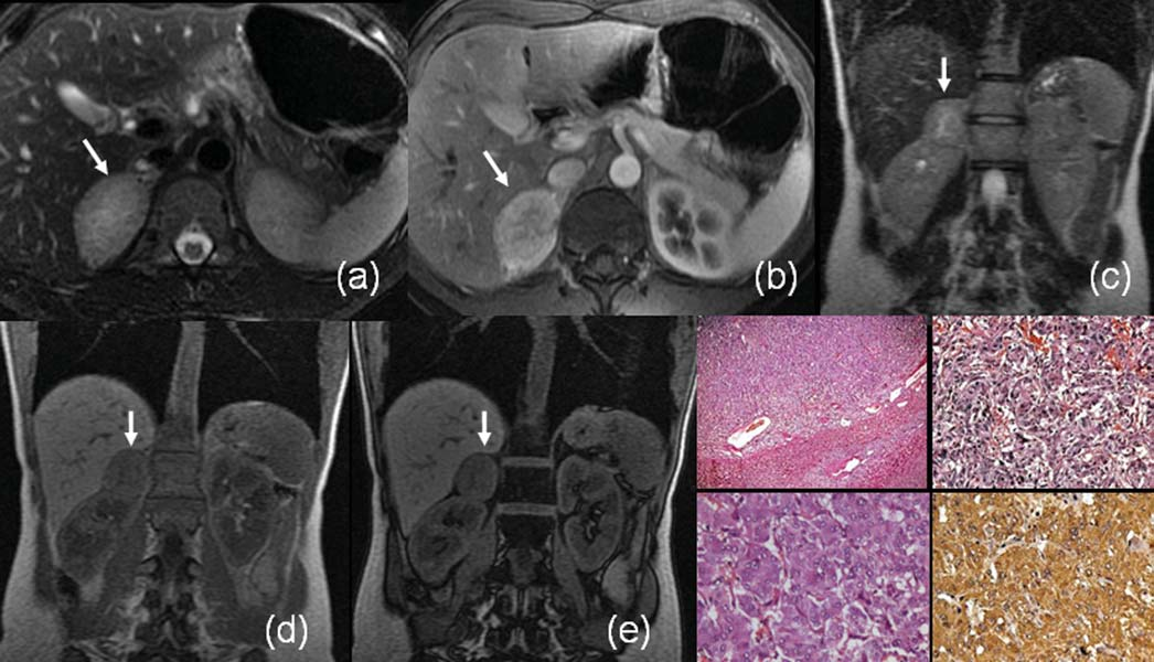 Martins DL et al. retroperitoneal de baixo grau ou até com angiomiolipoma exofítico renal. Nas imagens multiplanares, porém, geralmente é possível demonstrar a origem da lesão (3).