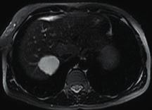 A B C D E F G H Fig. 1. Hemangioma típico adjacente a HNF em RM e CEUS. (A e B) A lesão (hemangioma indicado pelas setas brancas) é muito hiperintensa em T2 e hipointensa em T1.