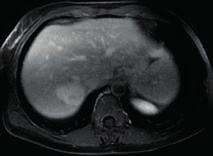 A trombose aguda pode ser diagnosticada quando os hemangiomas aparecem hiperatenuados na TC sem contraste e hiperintensos na RM ponderada em T1.